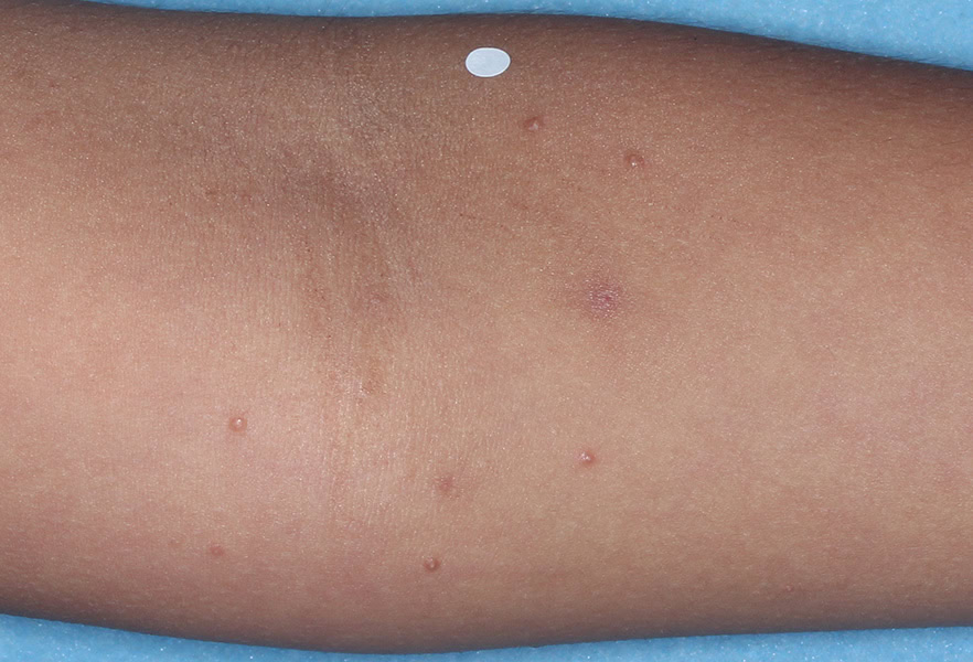 VP-102-101_009_0006_Treatment Visit 1_4850814