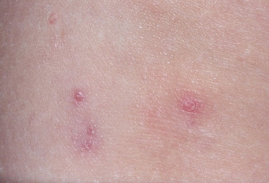 VP-102-101_009_0008_Treatment Visit 1_4857056