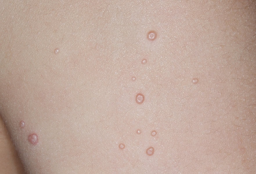 VP-102-101_009_0010_Treatment Visit 1_4874532