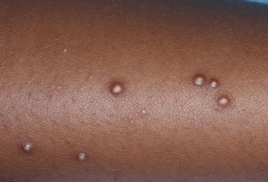 VP-102-101_009_0013_Treatment Visit 1_4916292