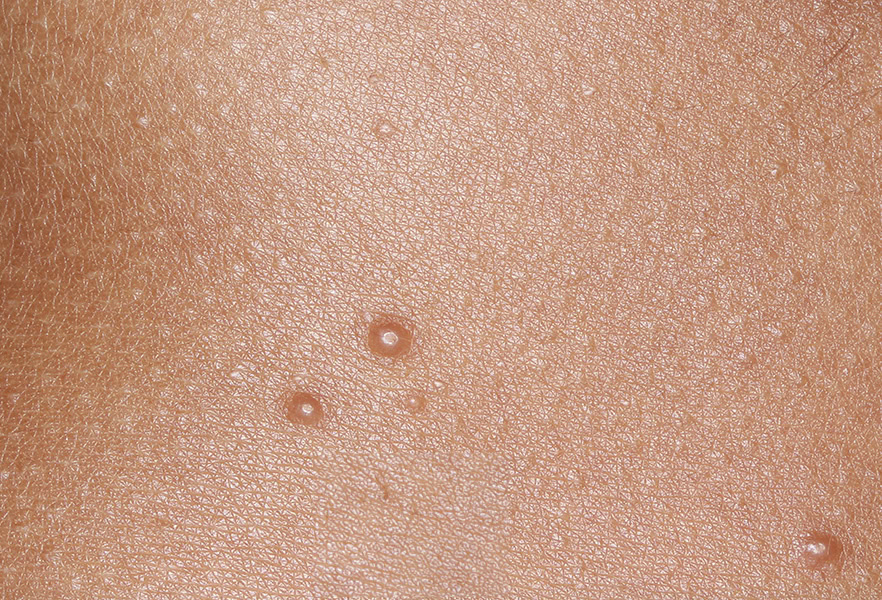 VP-102-101_009_0017_Treatment Visit 1_4943805