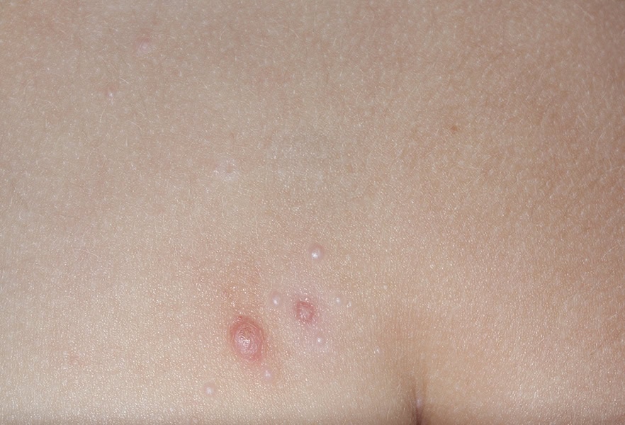 VP-102-101_009_0023_Treatment Visit 1_5009705