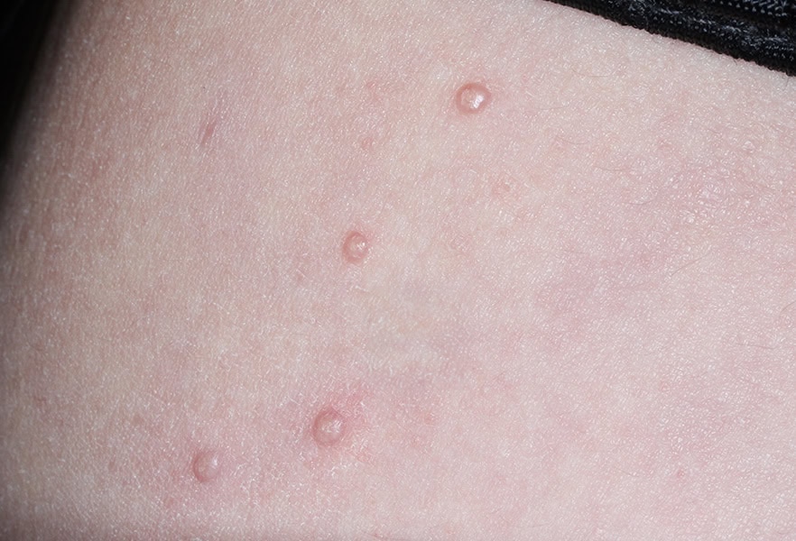 VP-102-101_009_0024_Treatment Visit 1_5018945