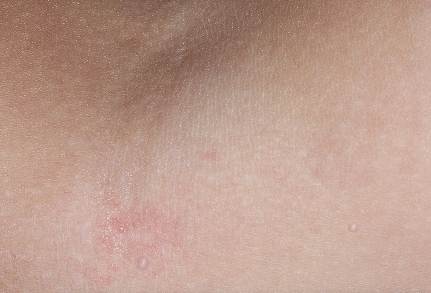 VP-102-101_009_0026_Treatment Visit 1_5019066