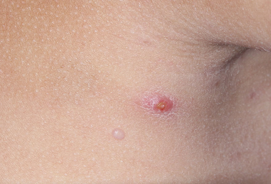 VP-102-101_009_0026_Treatment Visit 1_5019068